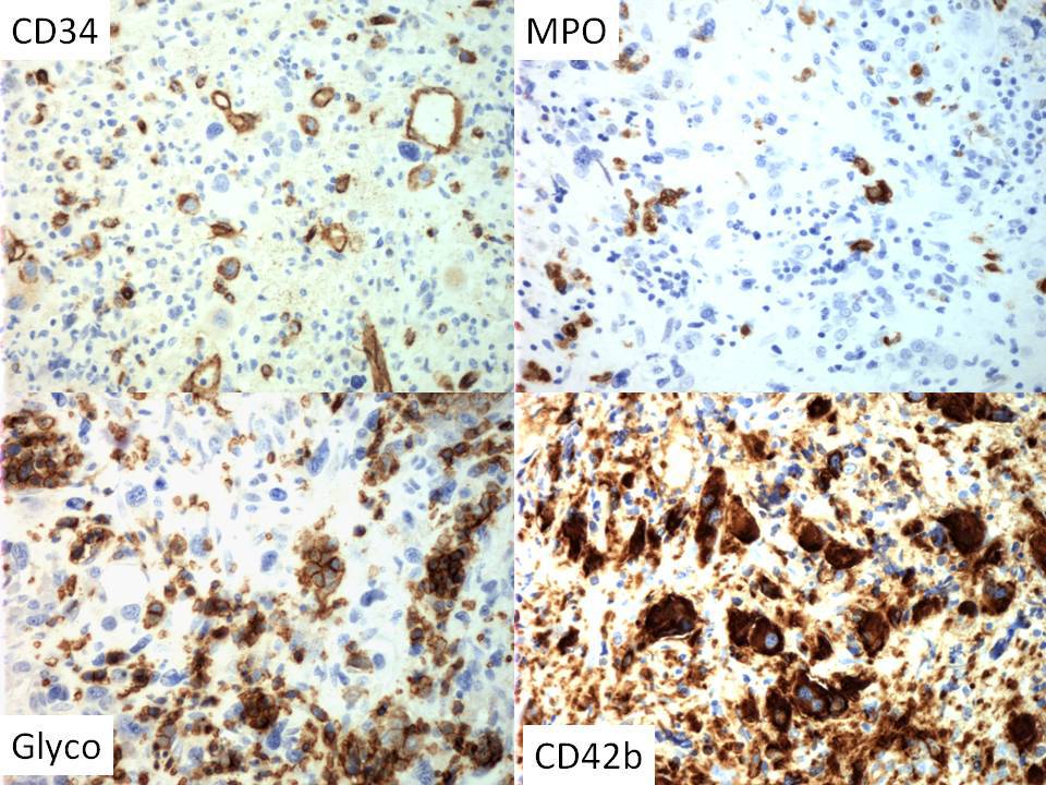 CD34 stains slightly increased scattered blasts. MPO demonstrates decreased granulopoiesis. Glycophorin C stains maturing erythropoiesis. CD42b shows numerous dysplastic megakaryocytes, including micromegakaryocytes.